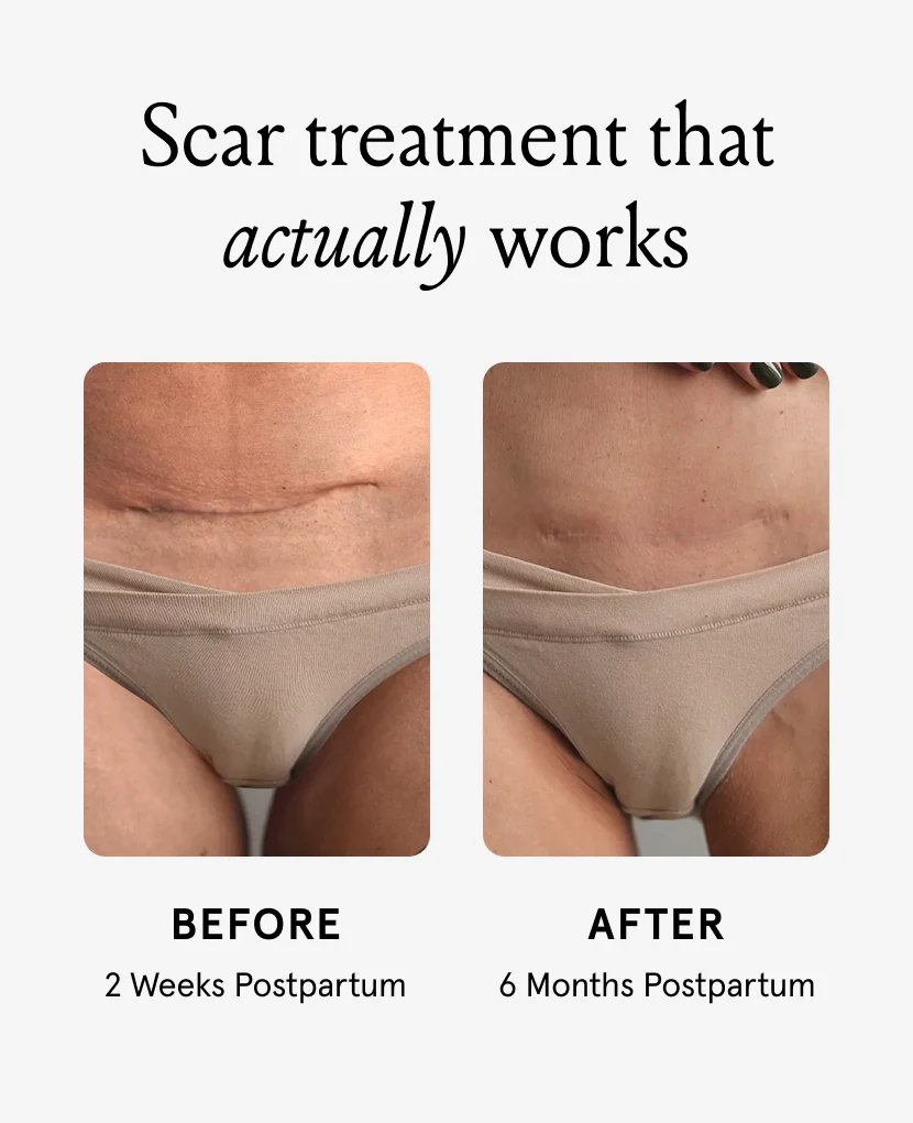 Nēmah Renewing Scar Cream - Image 4